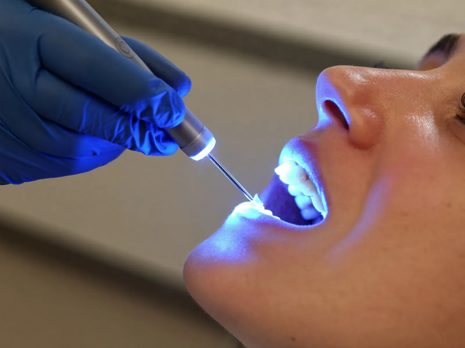 Dentista usando uma luz de fotopolimerização azul durante o tratamento